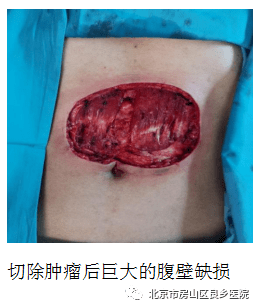 良乡医院成功完成首例腹直肌肌皮瓣转移术