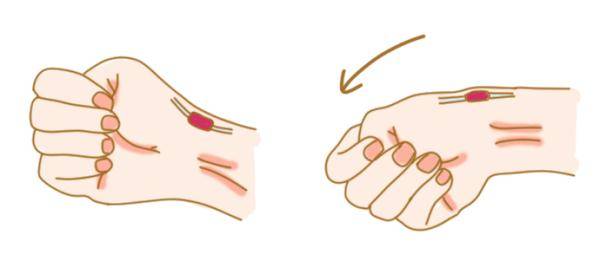 向小指侧偏手腕轻轻往下压;握拳尺偏试验(finkelsteins test)1个动作