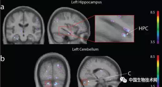 灰质|阿尔兹海默症和电子游戏