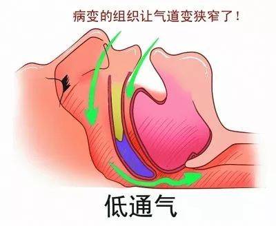 打鼾的人注意呼嚕聲越大越要抓緊看