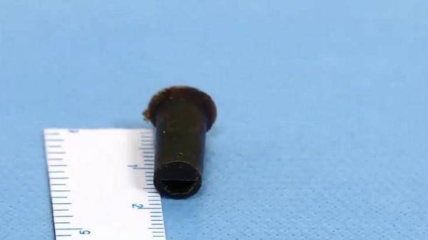 小林|男子6岁时吞了个…怕被家长骂，竟瞒了20年