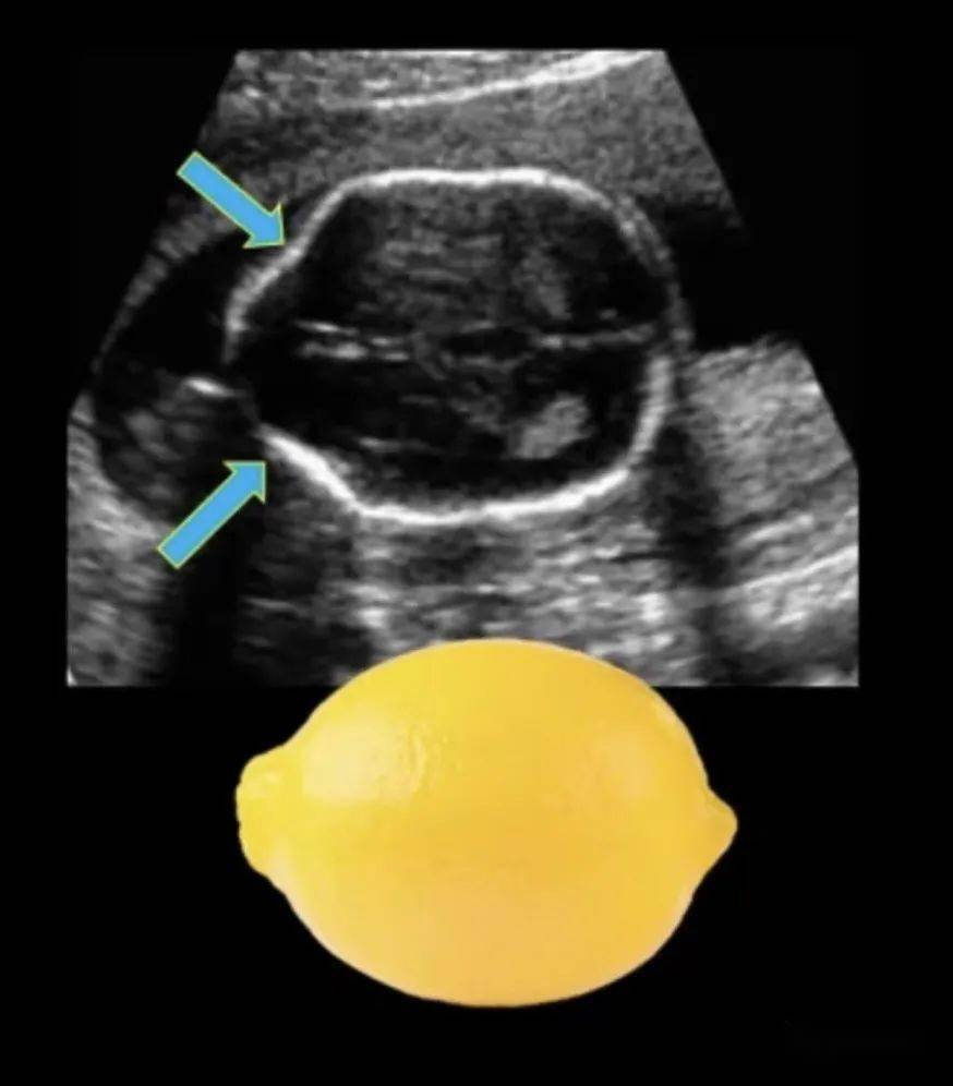 78柠檬征开放性脊柱裂中,97%胎儿在24周前有香蕉小脑征.