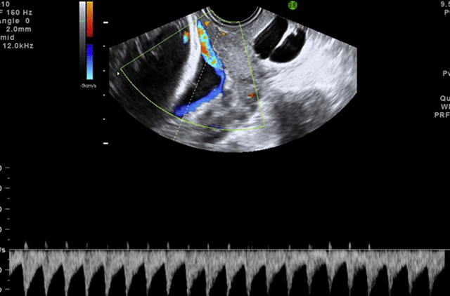 血管前置产前超声诊断(二)_脐带