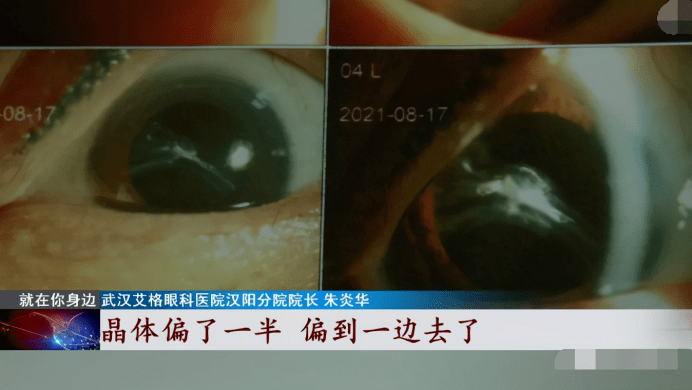 晶体|震惊了！这种方法治疗脱发竟导致眼睛晶体脱落，大妈们要警惕了...