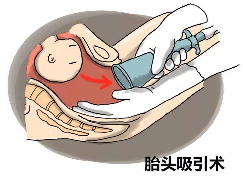 神秘阴道助产术关键时刻帮您免去一刀之苦