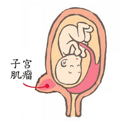 更糟糕的是子宫肌瘤的位置,不偏不倚长在了子宫前壁下段,阻挡了胎头的