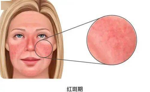科普之星认识玫瑰痤疮