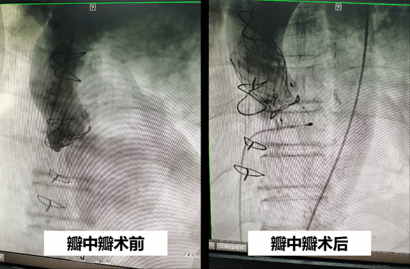 钟伯|七旬阿伯瓣膜病变只能“坐着睡”，新技术解决高龄换瓣难题