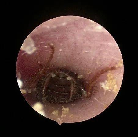 蟑螂|半夜耳朵痛醒，一查吓一跳！千万不要这样做