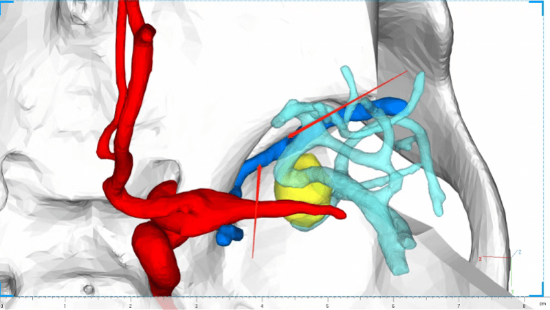 二医|高致死性脑动脉瘤破裂出血，3小时精准手术成功拆“炸弹”