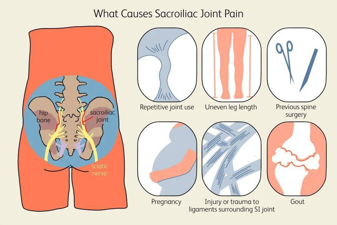 女性尾骶骨疼痛的原因图片