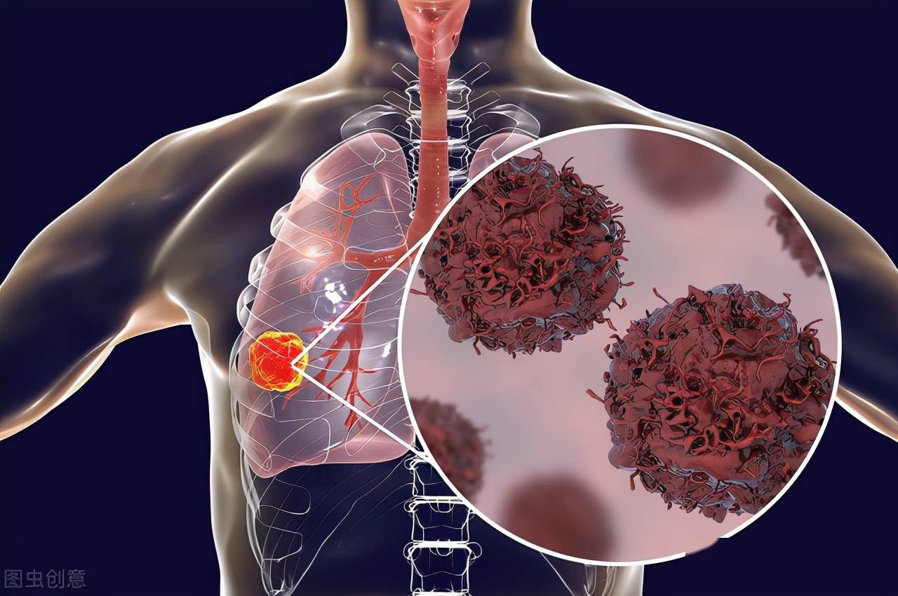 肺癌基因突变能活多久 针对基因未突变的肺癌