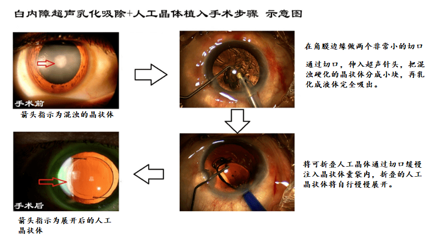 白内障手术示意图图片