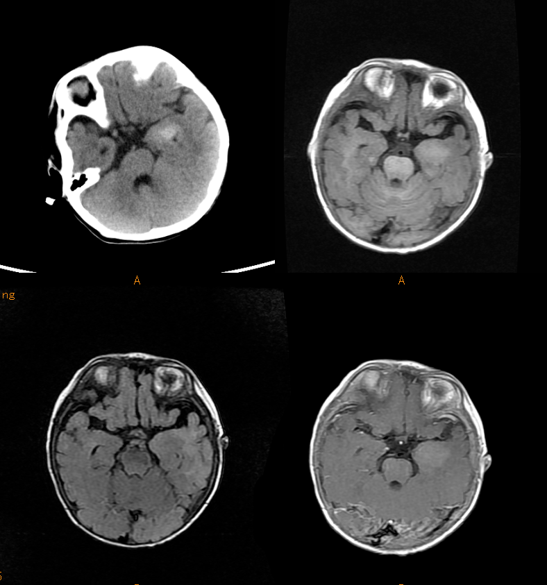 收藏兒童常見顱內腫瘤影像學盤點多圖