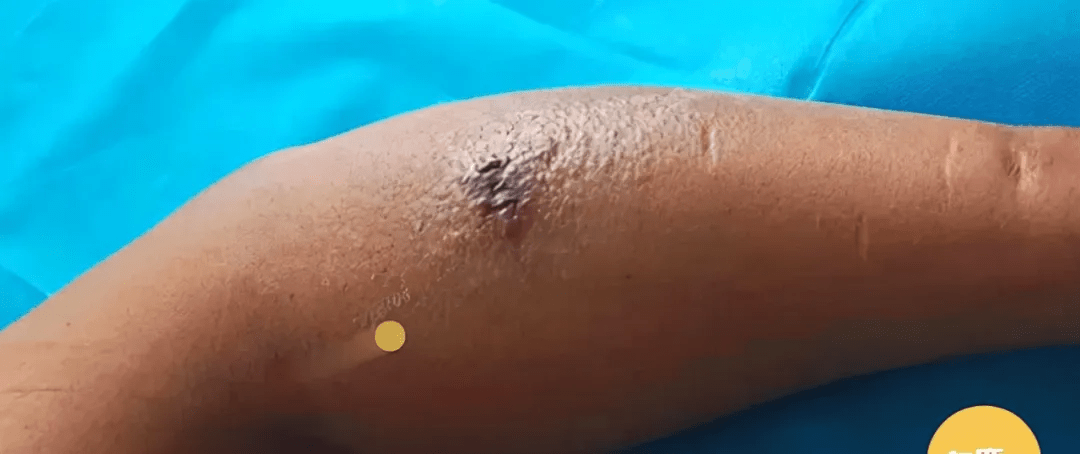 男子|男子被蚊子咬后发高烧险截肢，22天做了5场手术，医生紧急提醒