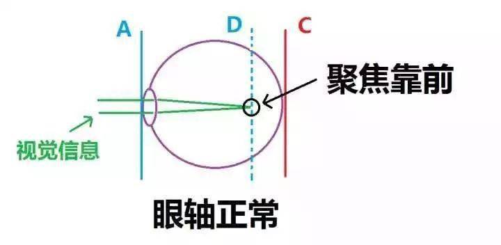 眼轴2525mm近视度数