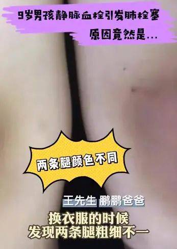 血栓|全国首例！9岁孩子患静脉血栓，跟这件事有关……