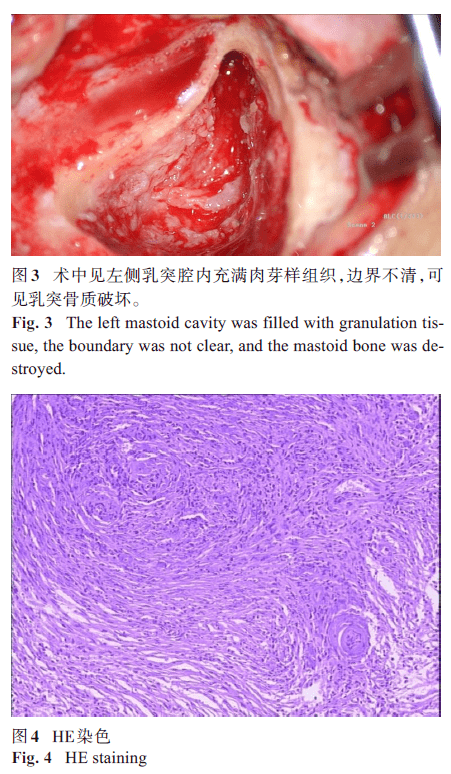 肌纤维母细胞瘤治疗图片