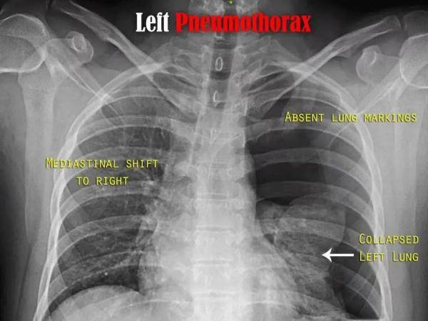 气球|29岁小伙几声剧咳，肺就“炸”了！