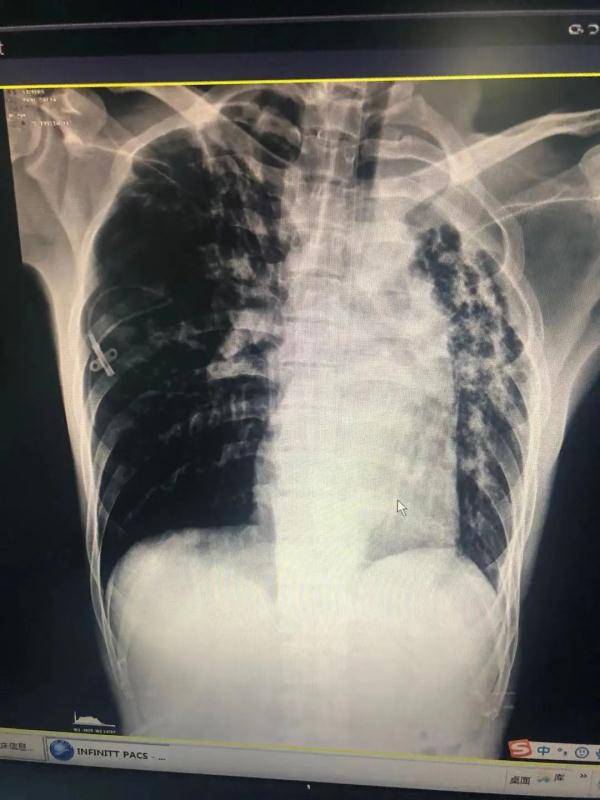 气球|29岁小伙几声剧咳，肺就“炸”了！