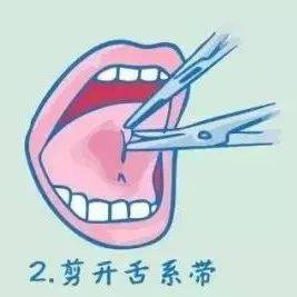 “剪舌筋”——该不该让孩子挨这一刀?_发音