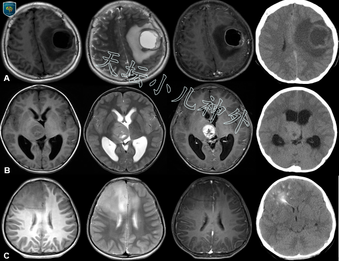 脑胶质瘤磁共振图片