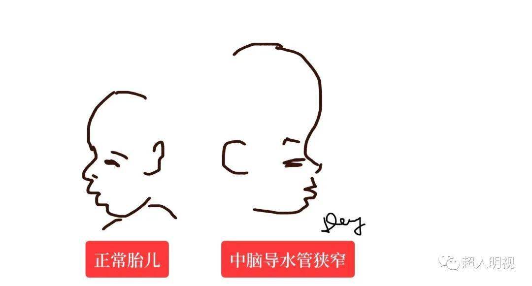 中脑导水管狭窄造成的脑积水,胎儿头大,额部前倾前突