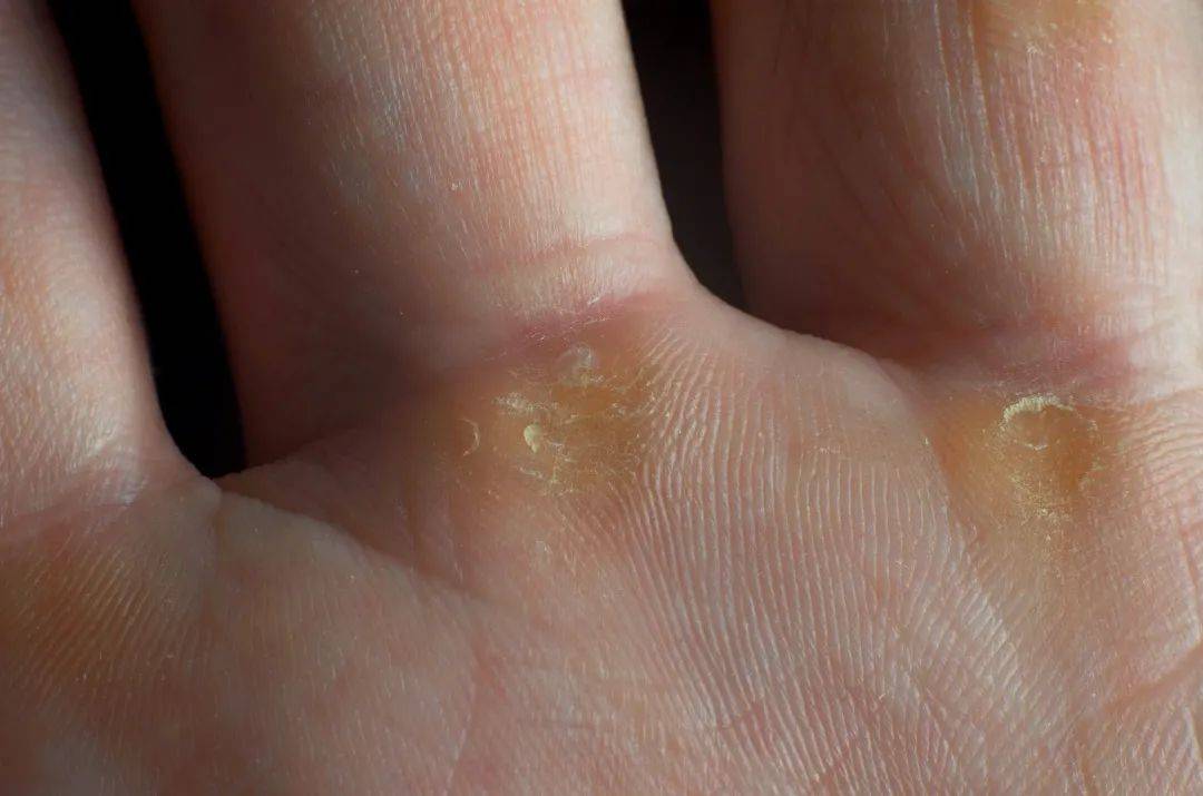 高跟鞋|“鸡眼”偏爱这4种人，你中招了吗？