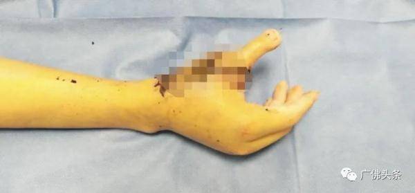 复活|妙手回春！脚趾移植到手上变大拇指，男子断指成功“复活”