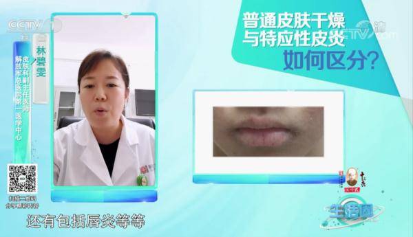 过敏性|皮肤干燥裂纹可能是病了？专家提到的这些情况莫大意