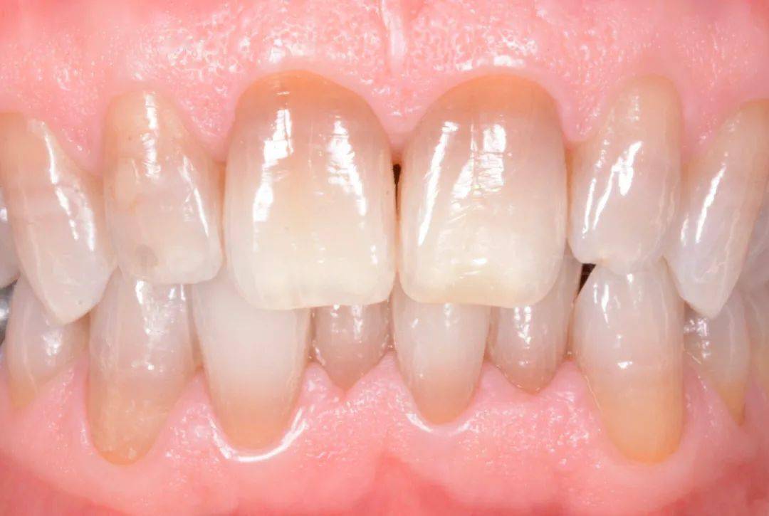 【牙医学堂】"无法漂白的"重度四环素牙漂白治疗