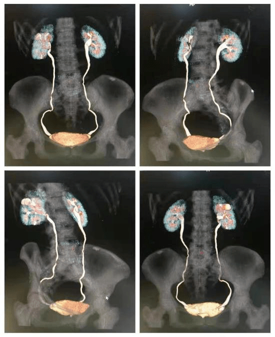 尿道ct图片