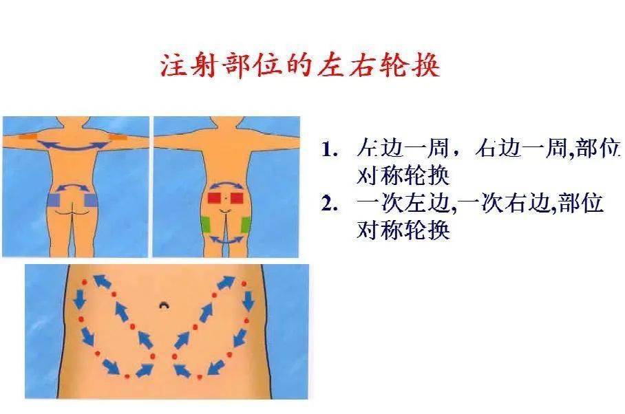 颞侧注射位置图片