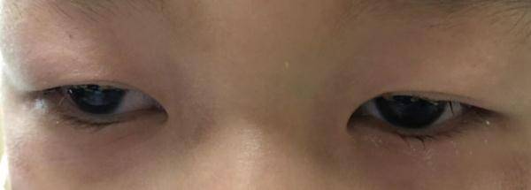 家长奇痒难耐，10岁女孩拔光眼睫毛，元凶竟是它！医生紧急提醒