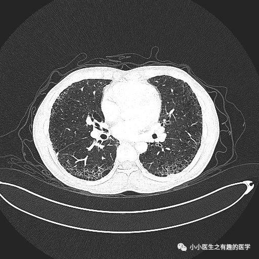 间质性肺炎的典型图谱