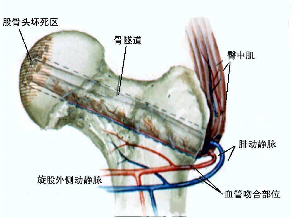 【健康医声】股骨头缺血性坏死知多少?