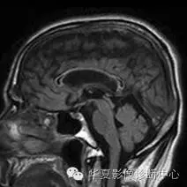 畸形|這 6 種典型影像征象的病變你都認識了嗎