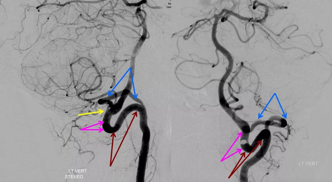 基础必学:椎动脉走形图谱