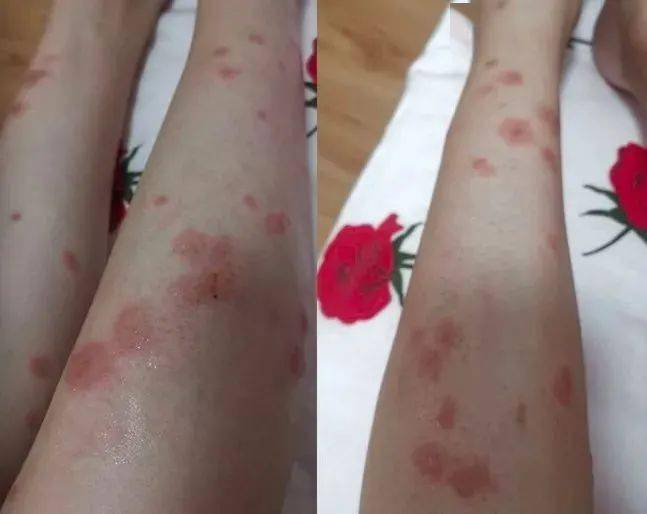 这种小飞虫咬人比蚊子猛6招能治它