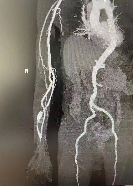 医患|【医患一家】最大限度保护血透患者“生命线”——北京积水潭医院肾内科完成首例CTA辅助超声引导下AVF合并AVG球囊扩张手术