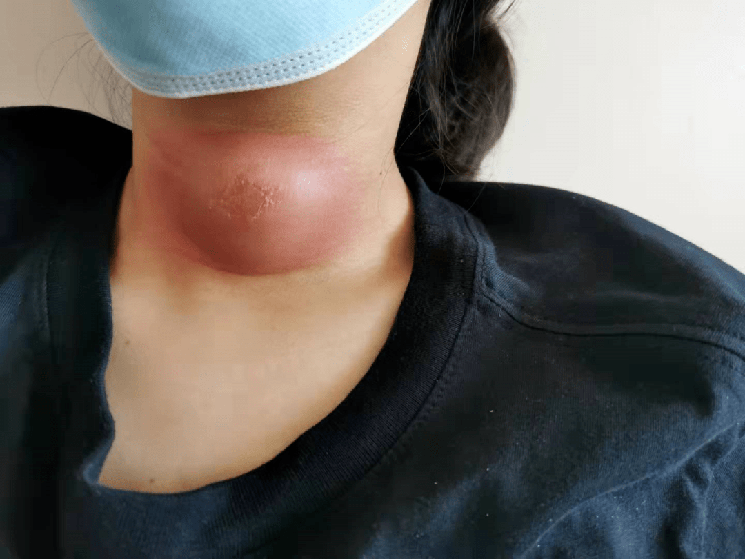 暑假期间妈妈发现女儿脖子正前方长了一个红疙瘩,拿着电蚊拍冲进孩子