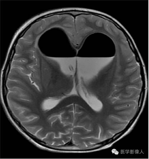 黄素环|脑内T2WI上低信号病变大致分为8大类【总结】