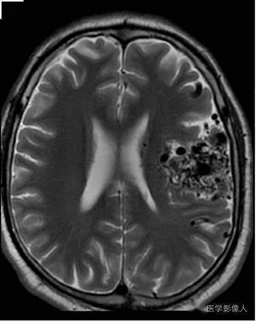 8大类脑内t2wi 低信号病变