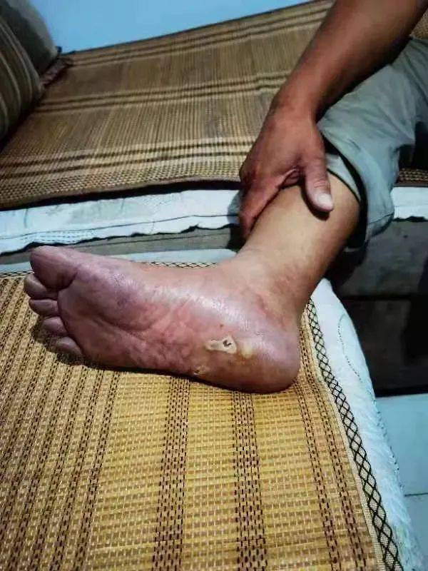 一觉醒来,叶红良突然觉得右脚底疼痛难忍,连路都不敢走,这才发现脚底