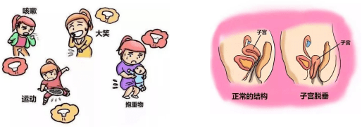 仁济科普 | 从"笑尿了也是病"开始,说说盆底超声那些事儿_疾病