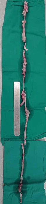 静脉|这种良性瘤很讨厌，沿着血管狂长差点堵死心房