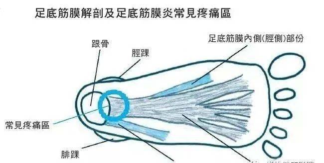 足底筋膜炎:行走的疼痛