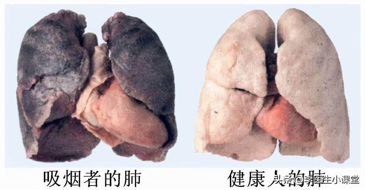 吸烟者的肺和不吸烟者的肺有着相当大的差异.