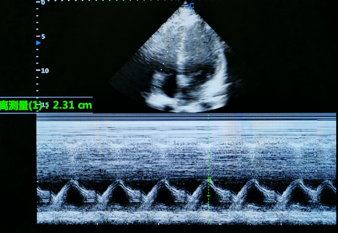 功能评估与左心室相同,采用脉冲多普勒法于三尖瓣上测量舒张期频谱(图