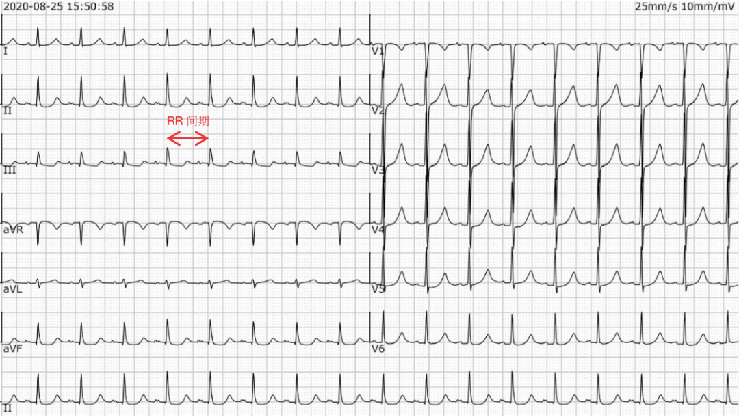 如何快速阅读心电图 a82ea820c2934daabb7e96640a01e933.png